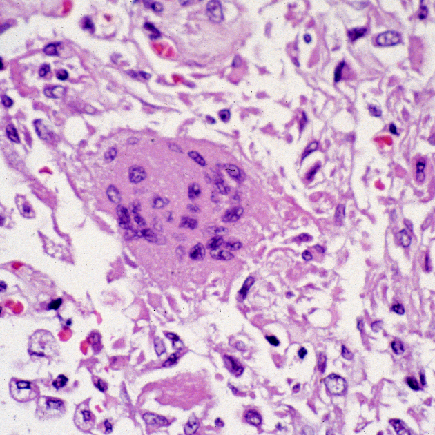 Specimen of lung tissue affected by SARS